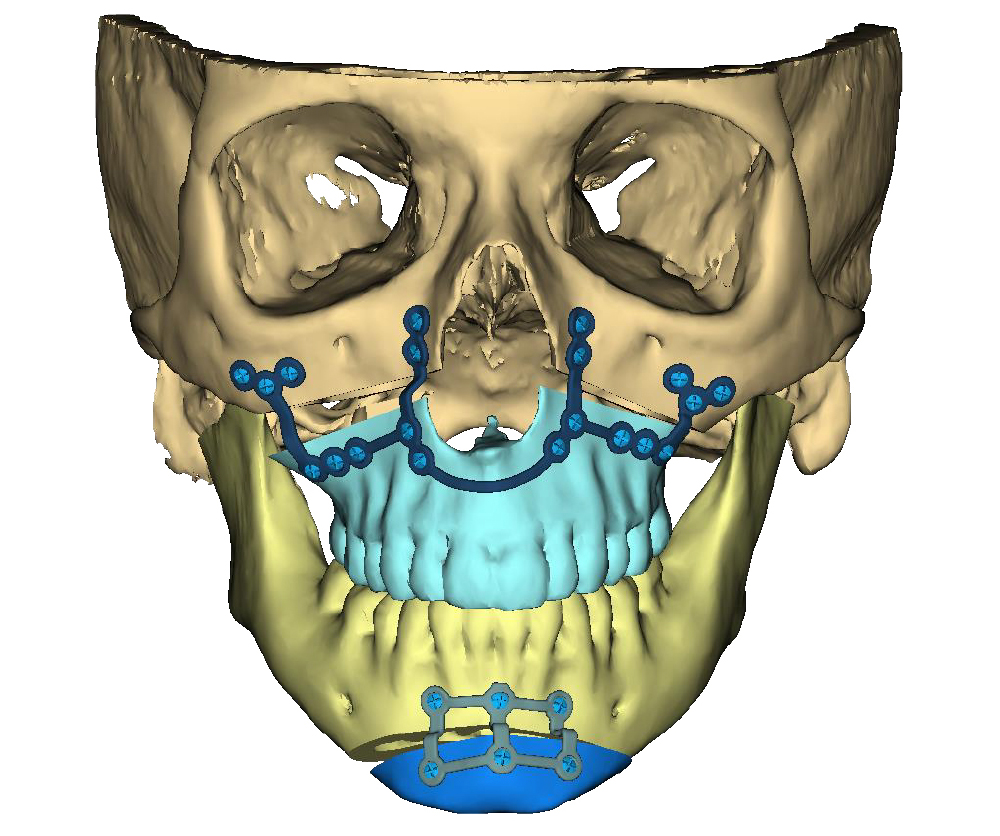 Virtual surgical planning for surgeries to realign lower jaw and chin and for TMJ replacement.